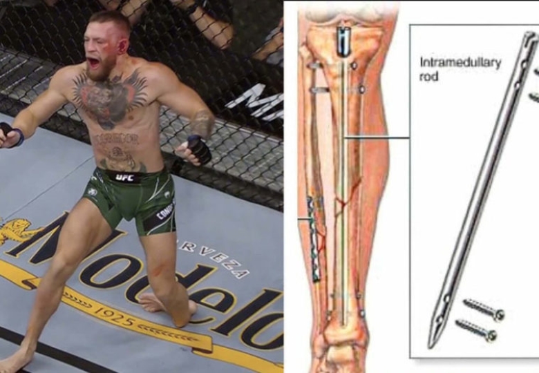 The sports medicine doctor talks about injuries, recovery and future opportunities of Conor McGregor in MMA - Photo 2