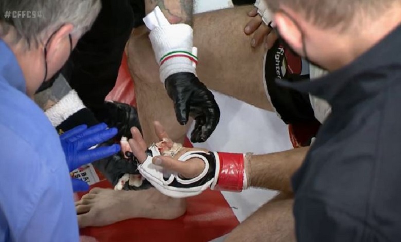 MMA boxer breaks his fingers when playing - Photo 2