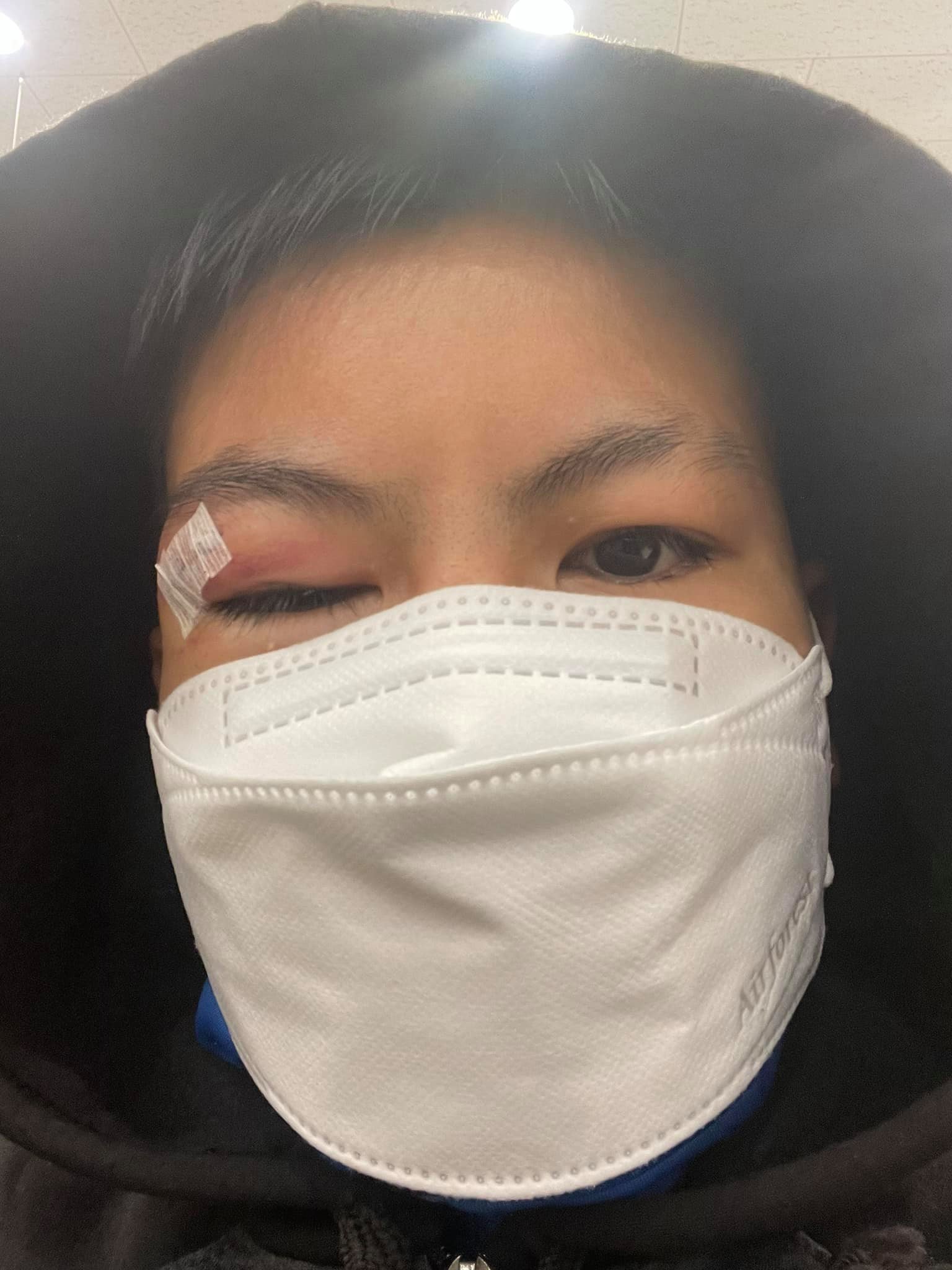 Champion Nguyen Thi Thu Nhi stitched 5 stitches after the battle of WBO belt - Photo 1