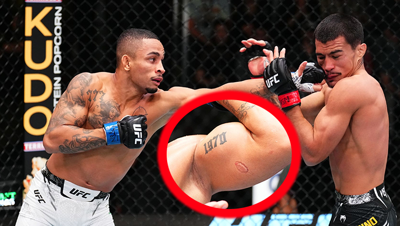 Being bitten by 'Suarez UFC', what did MMA boxer say? - Photo 1