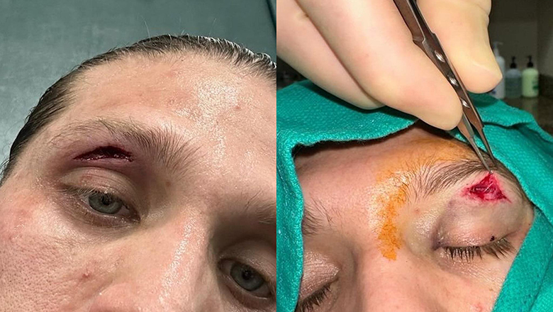 Coach Rener Gracie revealed the image of Brian Ortega's eye injury - Photo 2