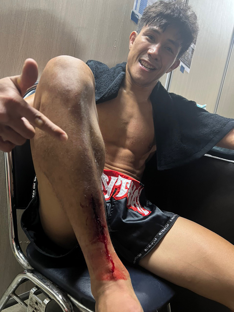Only 4 stitches after the victory at One Championship - Photo 1
