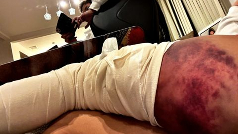 Takeru Segawa was hospitalized with a bruising left leg on the launch day of One Championship - Photo 1